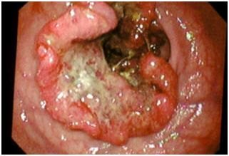 Immagine endoscopica del colon