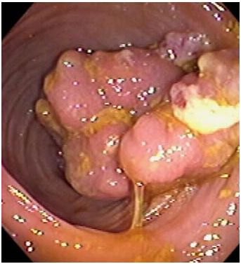 Immagine endoscopica del colon