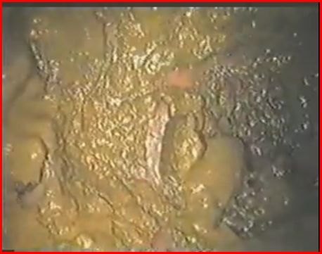 Immagine endoscopica del colon