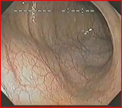 Immagine endoscopica del colon