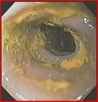 Immagine endoscopica del colon