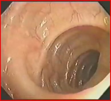Immagine endoscopica del colon