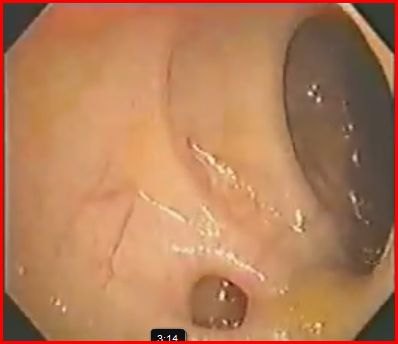 Immagine endoscopica del colon