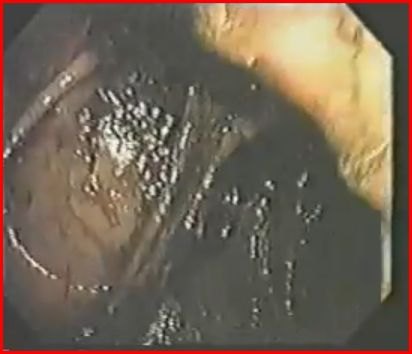 Immagine endoscopica del colon