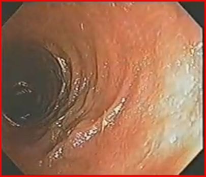 Immagine endoscopica del colon