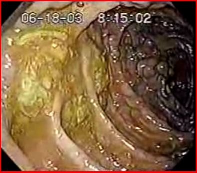 Immagine endoscopica del colon