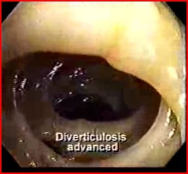 Immagine endoscopica del colon