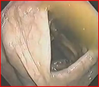 Immagine endoscopica del colon