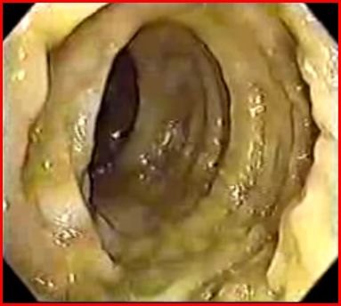 Immagine endoscopica del colon