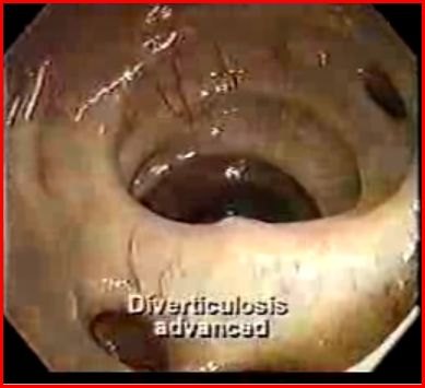 Immagine endoscopica del colon
