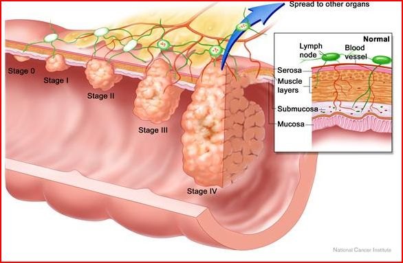 Illustrazione degli stadi di un tumore del colon